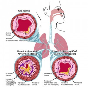 Asthma_Mild_Chronic