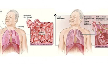 Capno 101: What is COPD?