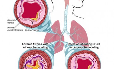 Capno 101: What is Asthma?