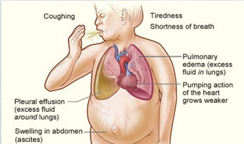 Capno 101: What Is Heart Failure? - Capnoacademy Capnoacademy