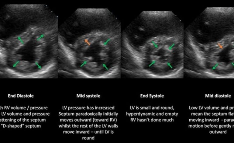 Identifying right ventricular failure