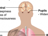 Capno 101: What is Opioid-induced Respiratory Depression?
