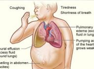 Capno 101: What is Heart Failure?