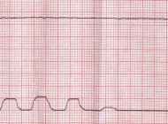 Rogue capno waves: Resuscitation team notes unusual waveform during CPR